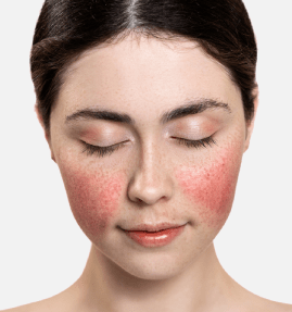 tratamiento-para-rosacea-clinica-maria-linda