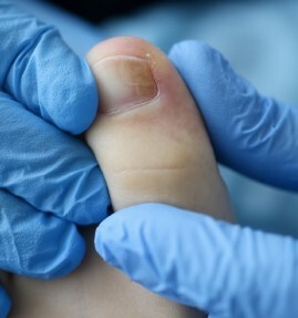piel-sensible-onicomicosis-maria-linda-dermatologos