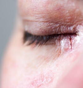 piel-sensible-psoriasis-maria-linda-dermatologos