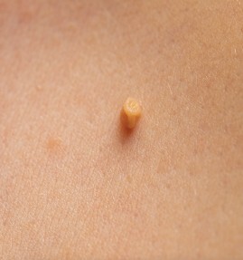 piel-sensible-verrugas-maria-linda-dermatologos