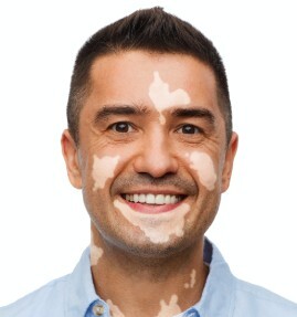 piel-sensible-vitiligo-maria-linda-dermatologos